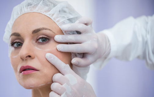 Ultra facelift combined approach