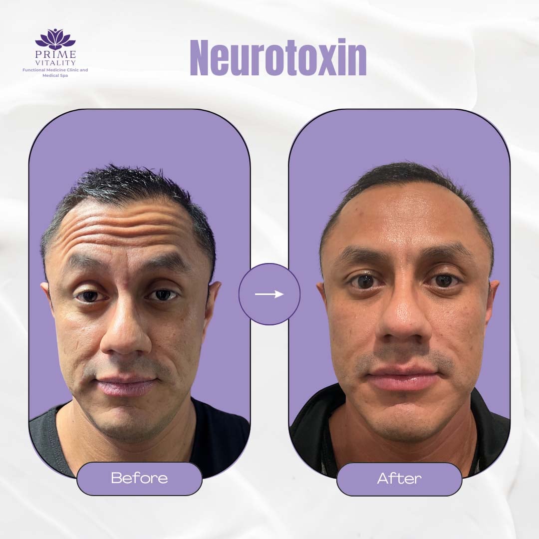 Before and after image showcasing the effects of neurotoxin treatment on a male patient, highlighting improved skin smoothness and reduced wrinkles at Prime Vitality Medical Spa.