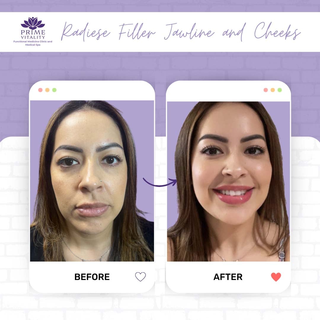 Before and after images showcasing the results of Radiesse filler treatment on jawline and cheeks, highlighting improved facial contours and enhanced smile at Prime Vitality Medical Spa.