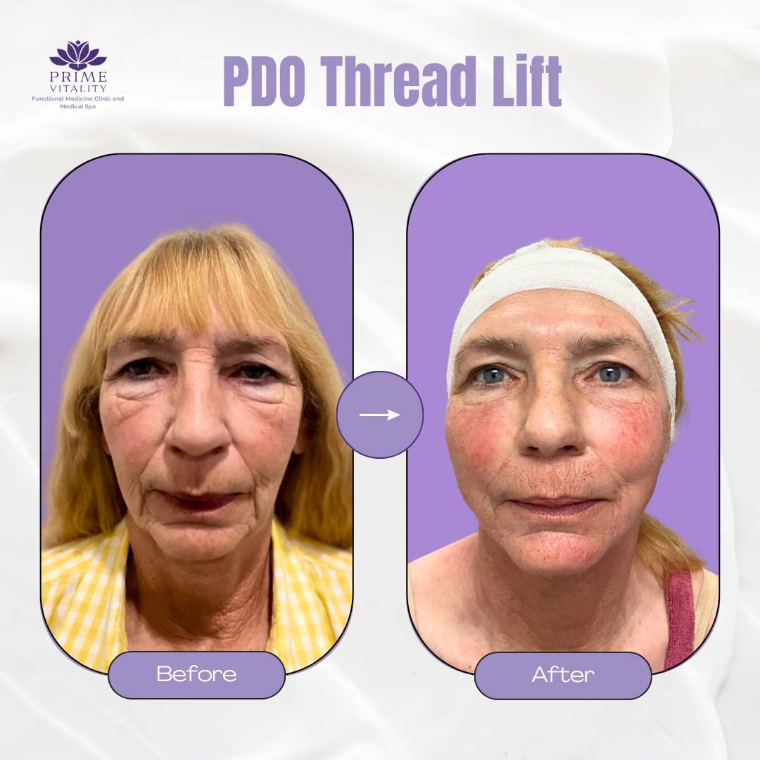 Before and after images of a PDO Thread Lift treatment showcasing significant facial rejuvenation results, highlighting enhanced skin tightness and improved facial contours, branded by Prime Vitality Medical Spa.