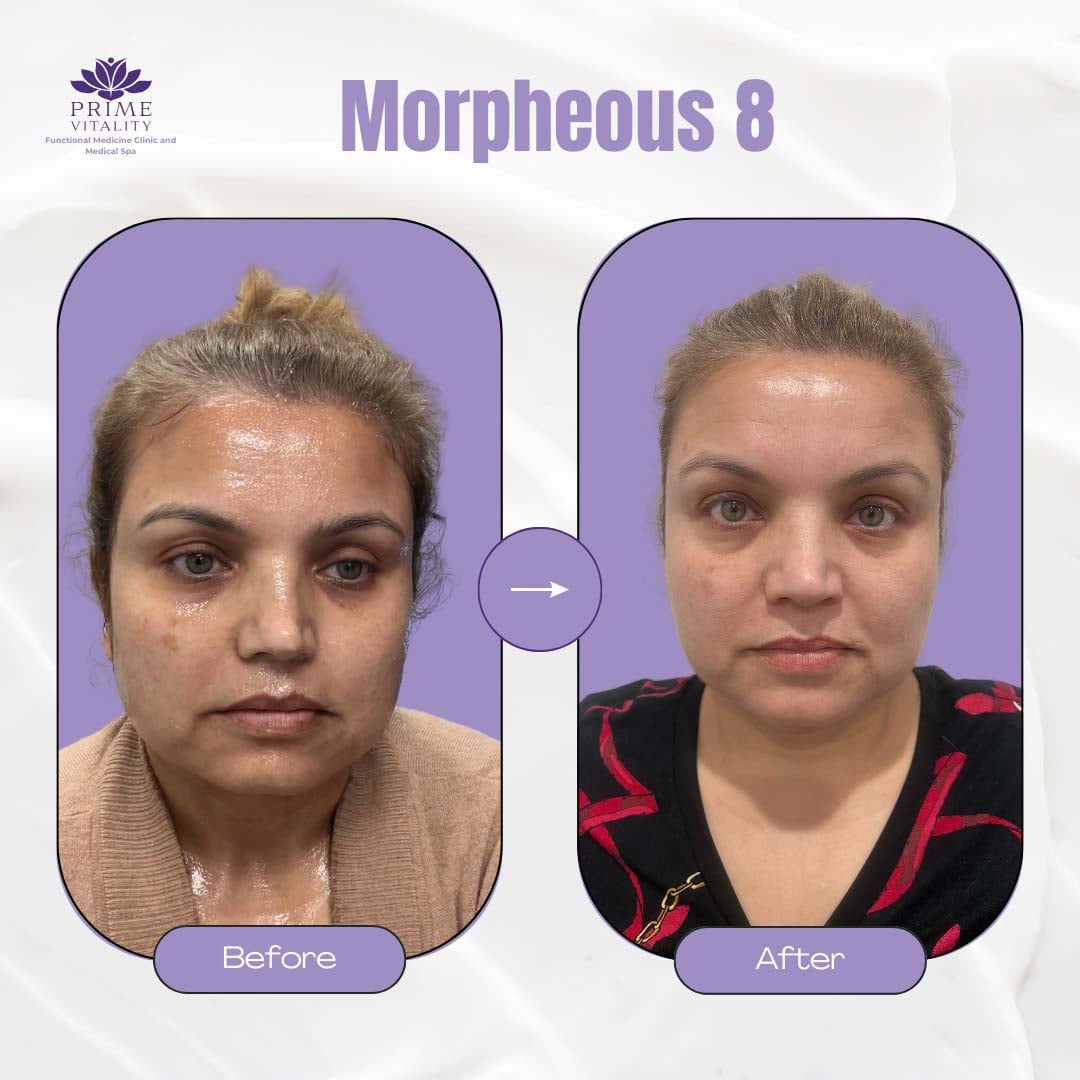 Before and after image showcasing a woman's facial transformation through Morpheus8 treatment at Prime Vitality Medical Spa, highlighting improved skin texture and appearance.