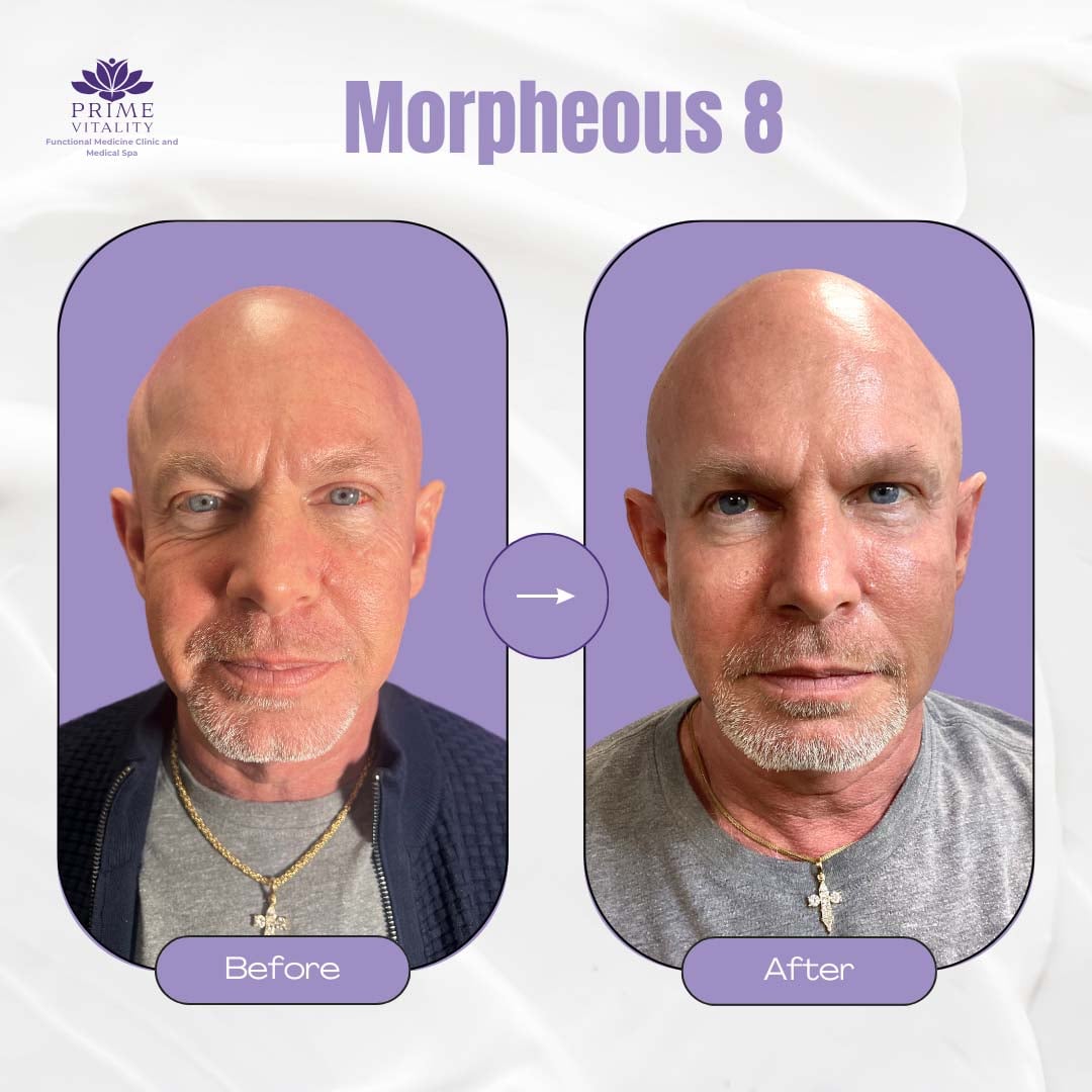 Before and after images showcasing the results of Morpheus8 treatment at Prime Vitality Medical Spa, highlighting significant skin rejuvenation and improved facial appearance.