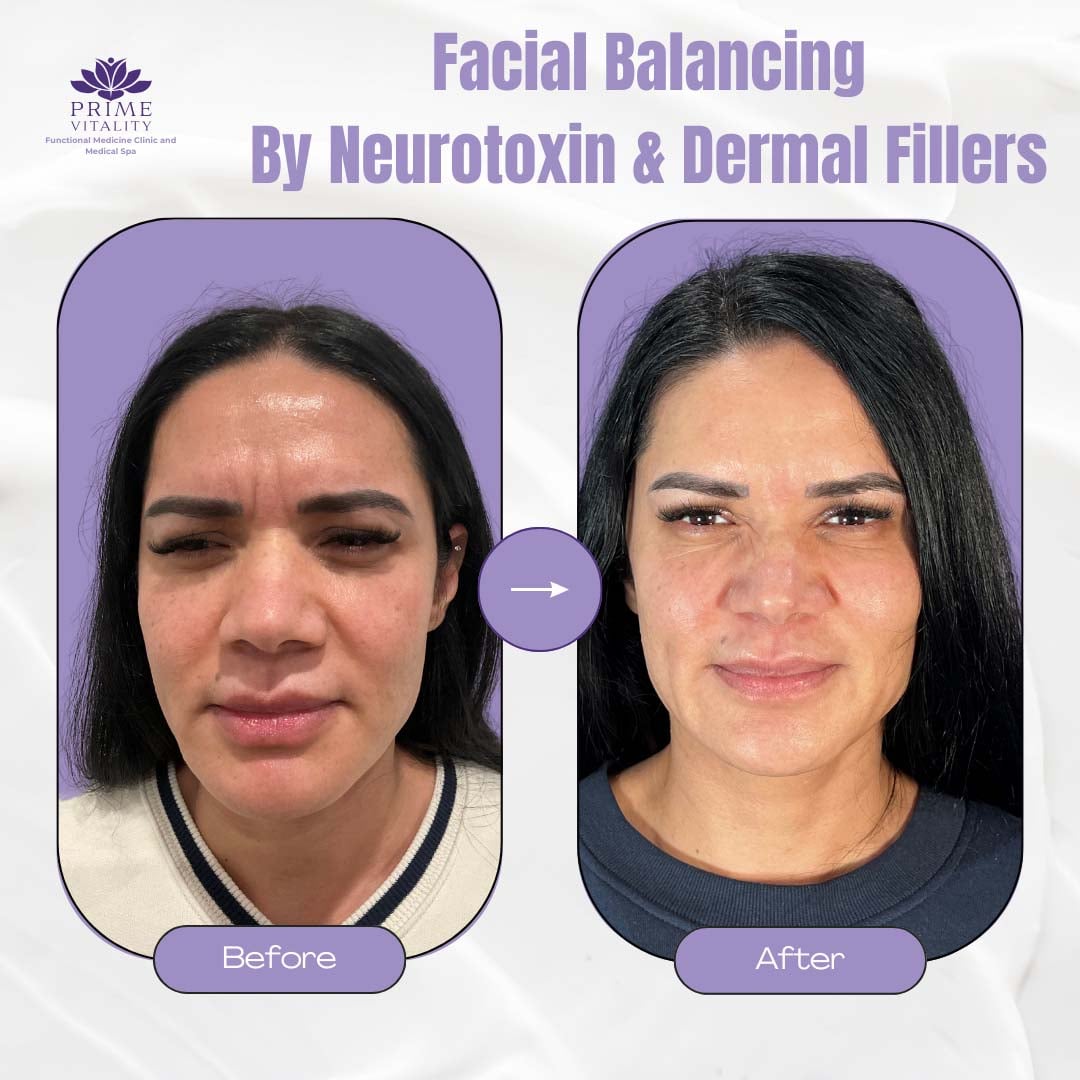 Facial balancing transformation before and after neurotoxin and dermal filler treatments at Prime Vitality Medical Spa, showcasing enhanced facial symmetry and rejuvenation.