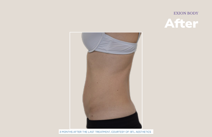 After abdomen