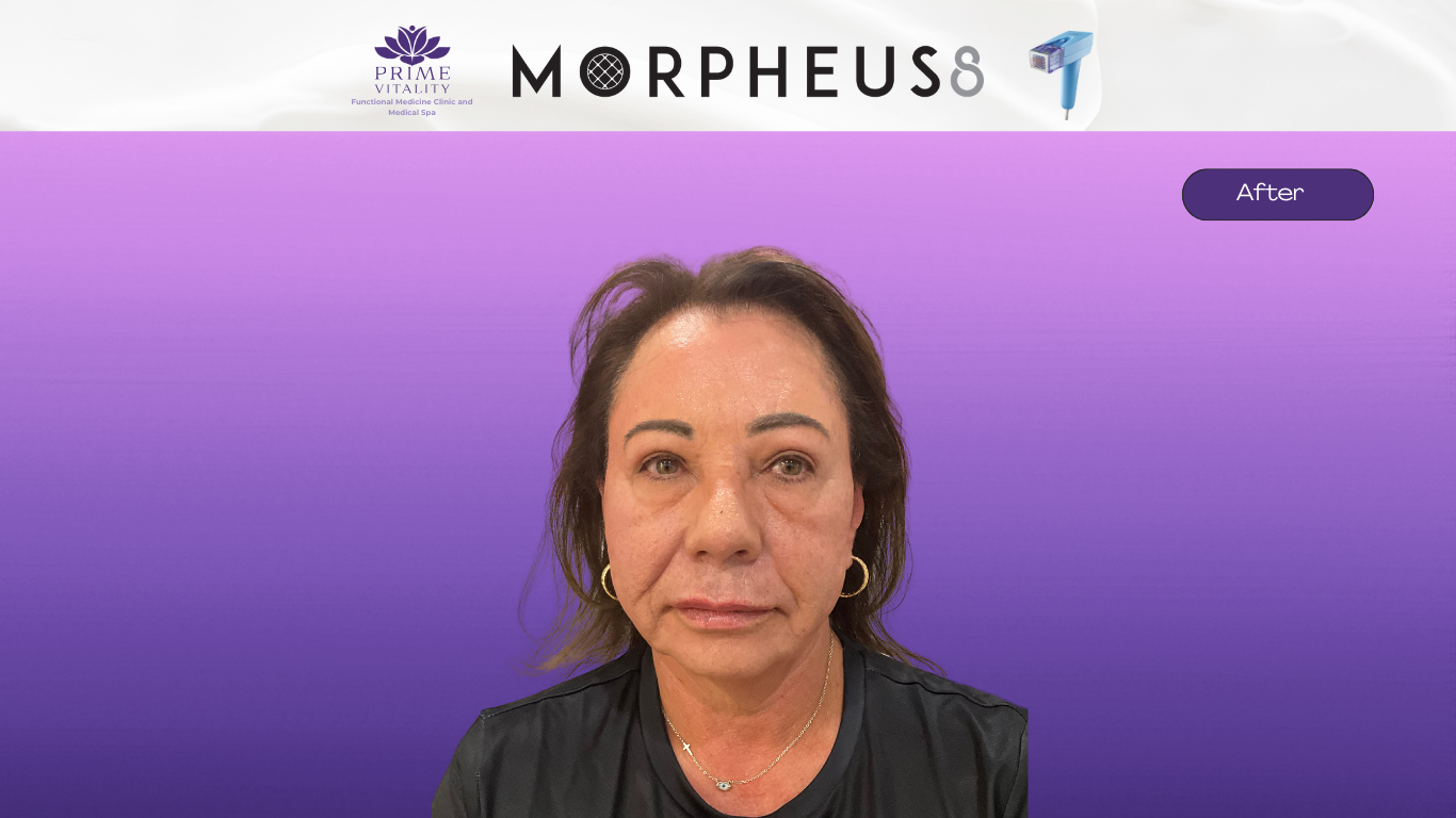 After Morpheus8 — significant scar improvement