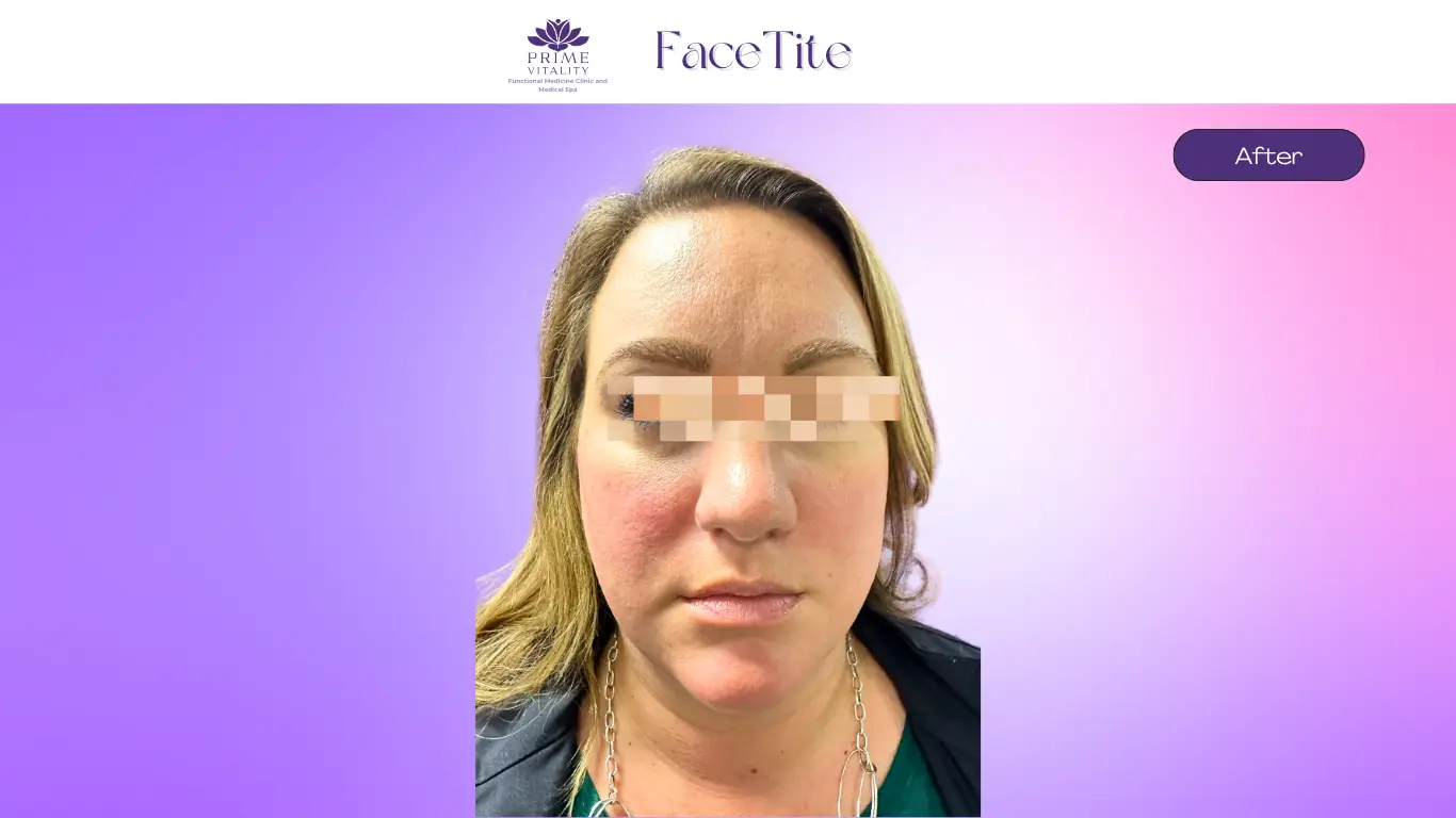 After FaceTite treatment