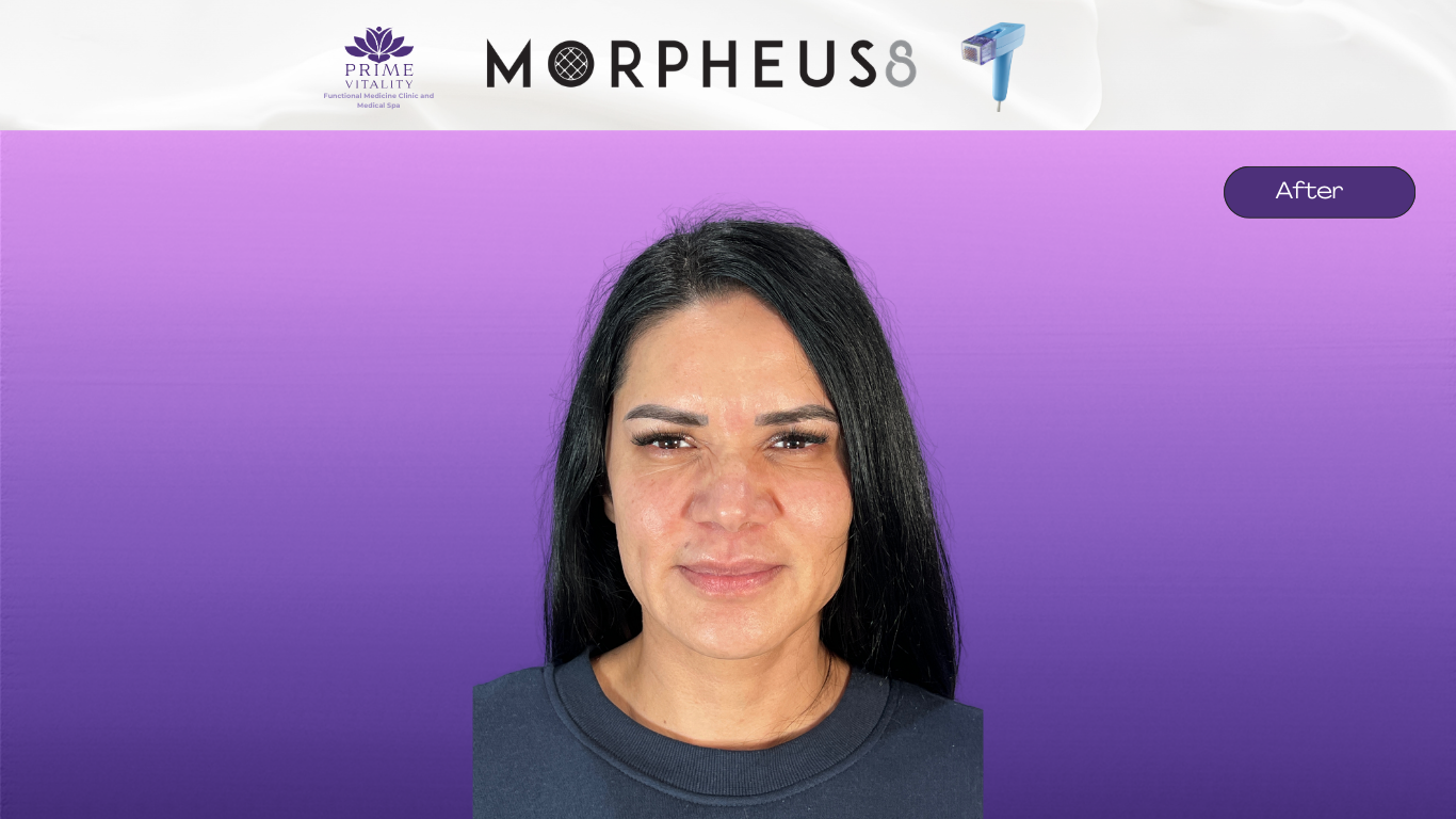 After Morpheus8 — smoother texture, reduced fine lines