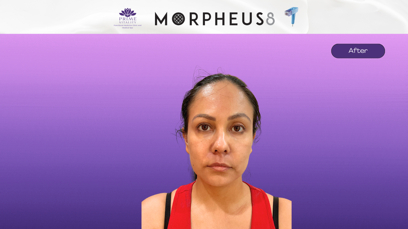 After Morpheus8 — tighter, more defined jawline
