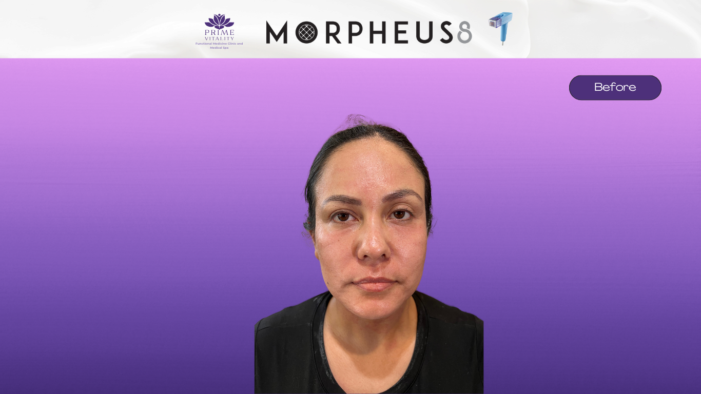 Before Morpheus8 — skin laxity along jawline