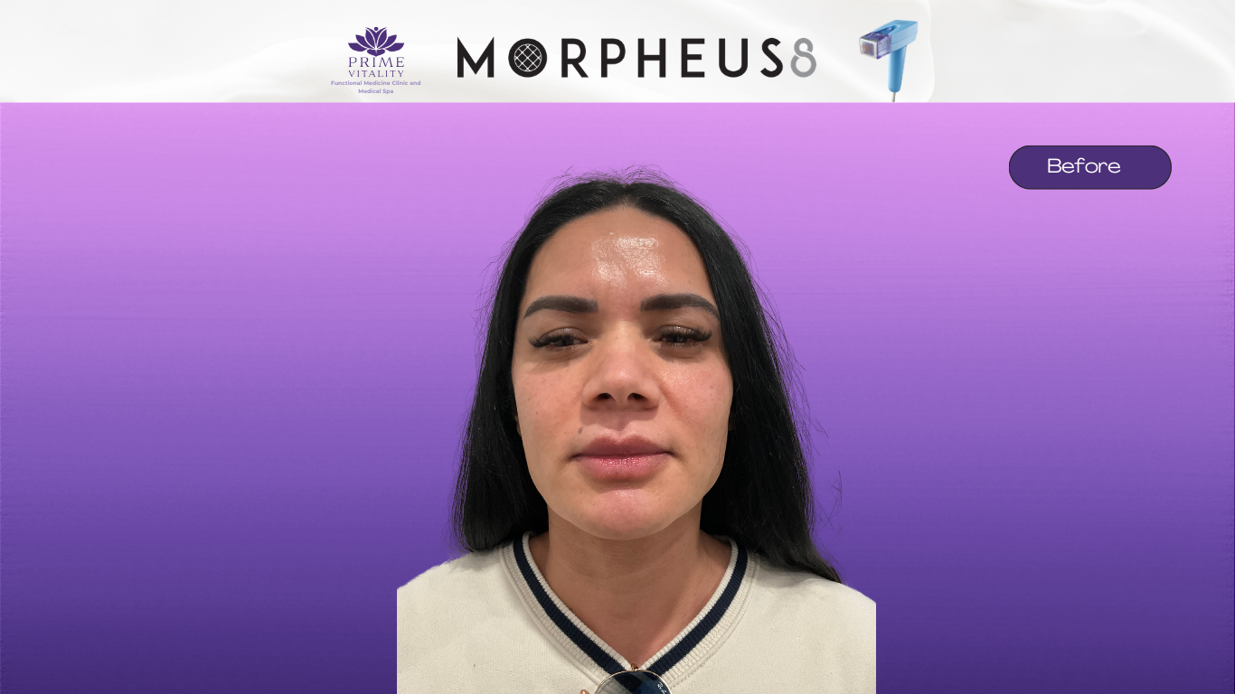 Before Morpheus8 — fine lines and uneven texture