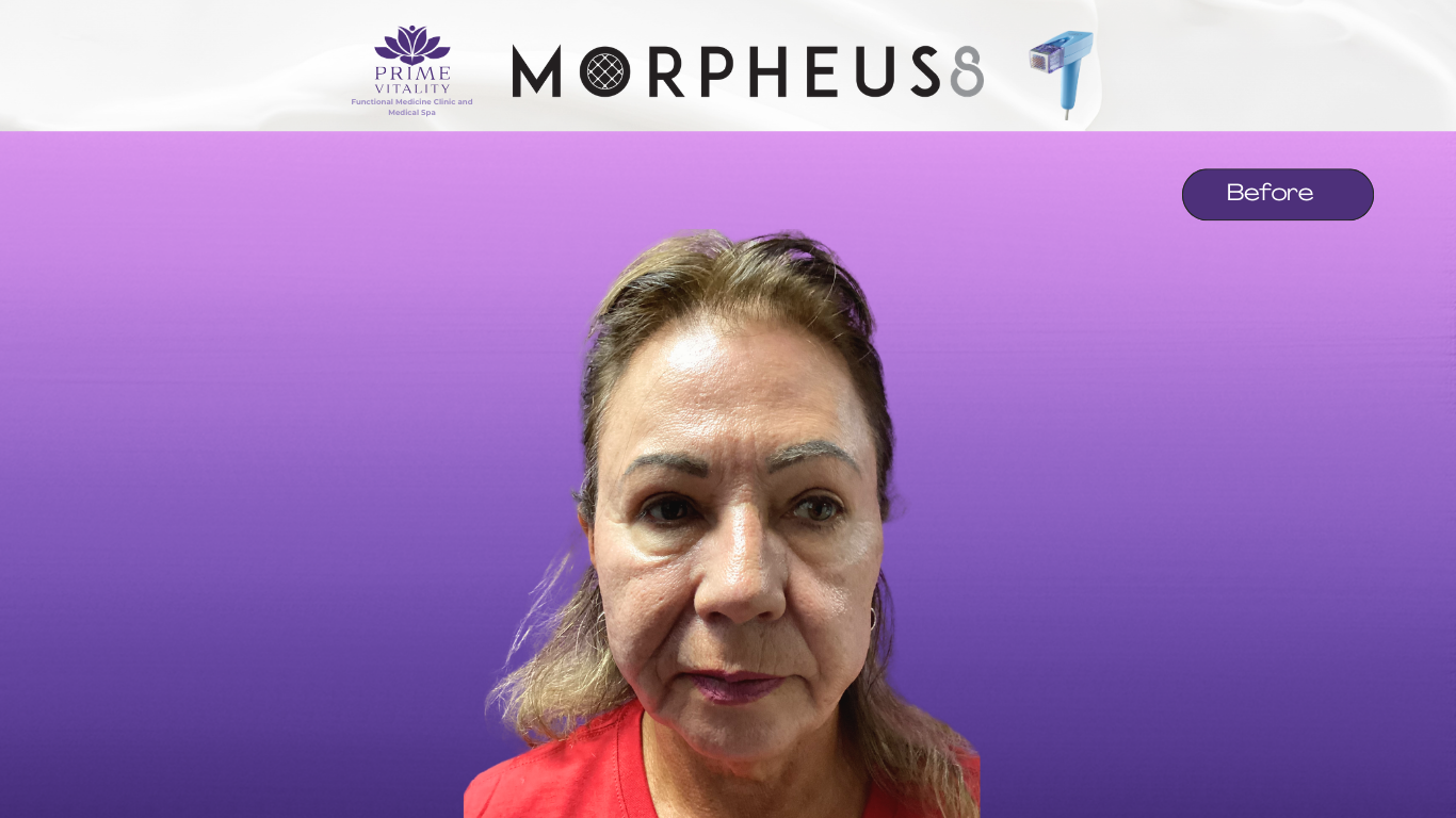 Before Morpheus8 — acne scarring