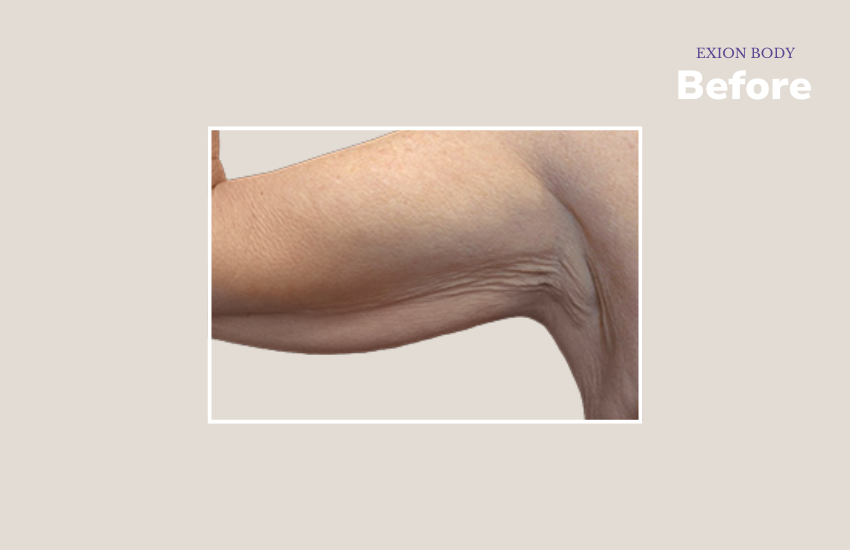 Before arms