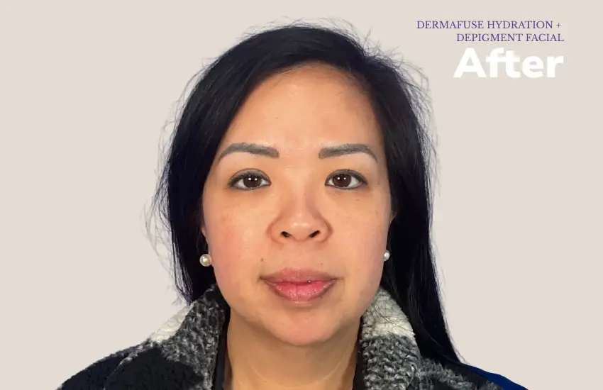 After microneedling — youthful skin
