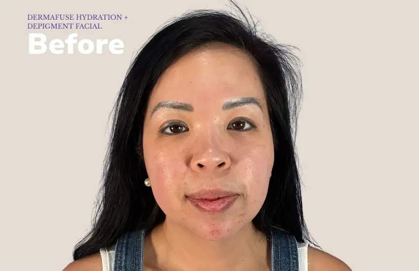 Before microneedling — fine lines