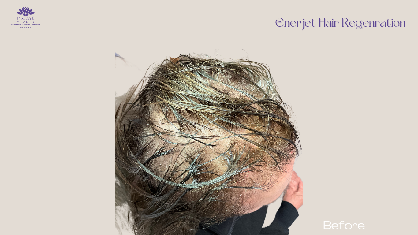 Female scalp before Enerjet treatment