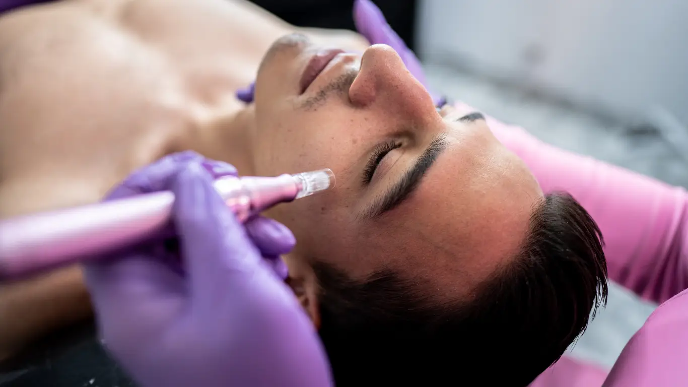 Microneedling skin treatment