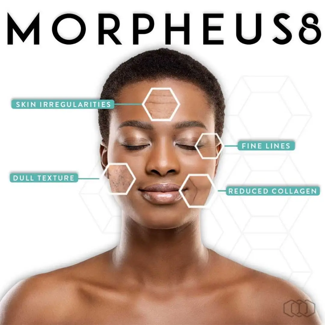 Morpheus8 RF microneedling at Prime Vitality Care
