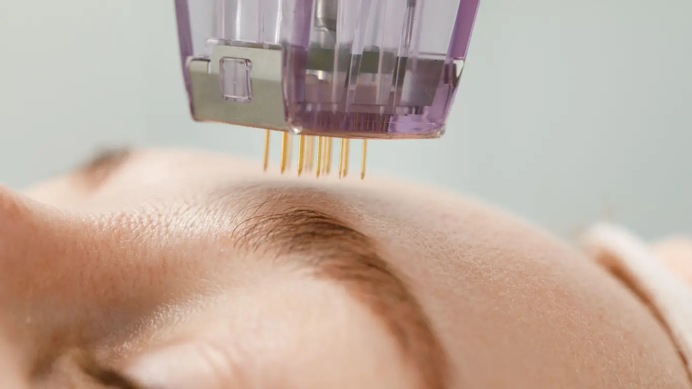 Microneedling device with 24 blunt pins delivering radiofrequency energy for superficial skin resurfacing and collagen stimulation during RF resurfacing treatment.