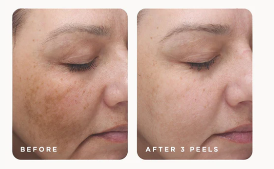 Chemical peel before and after for hyperpigmentation