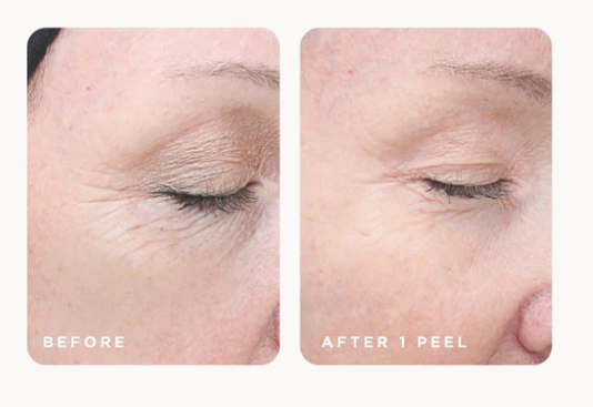 Chemical peel before and after for sun damage