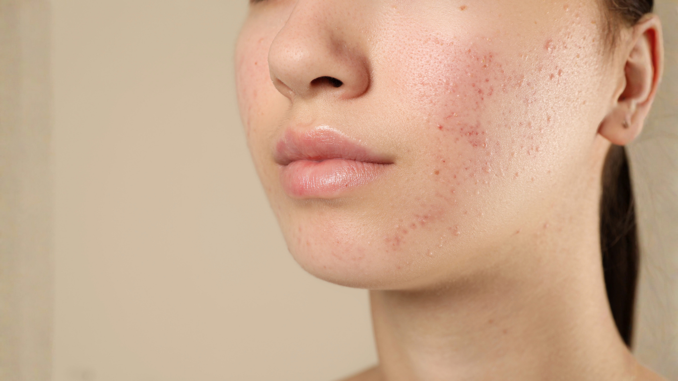 After microneedling — improved skin clarity