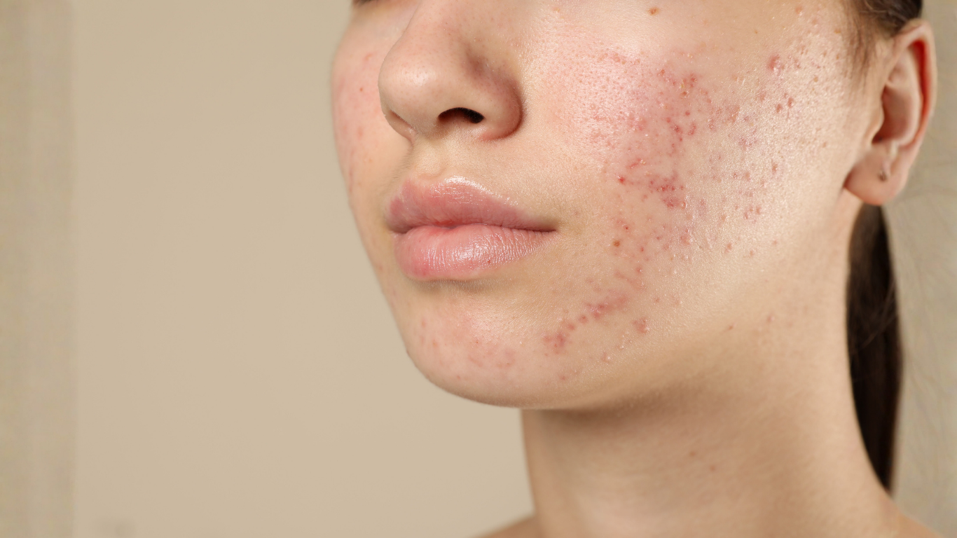 Before microneedling — acne scarring