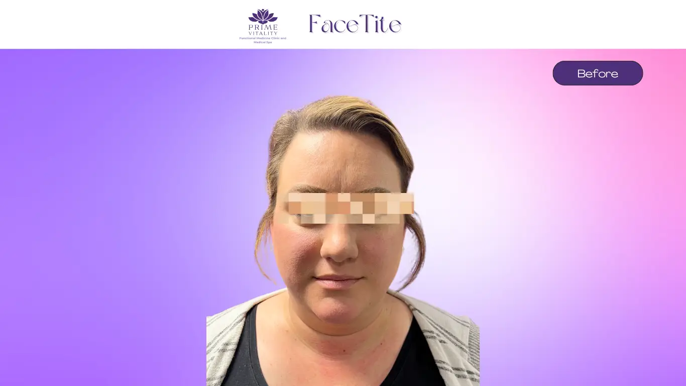 Before FaceTite treatment