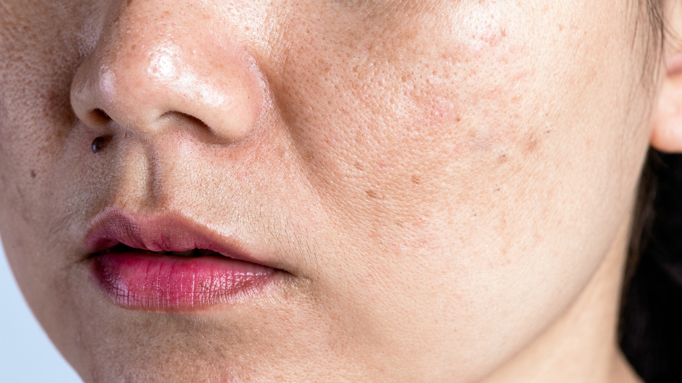 Enlarged pores on skin close-up