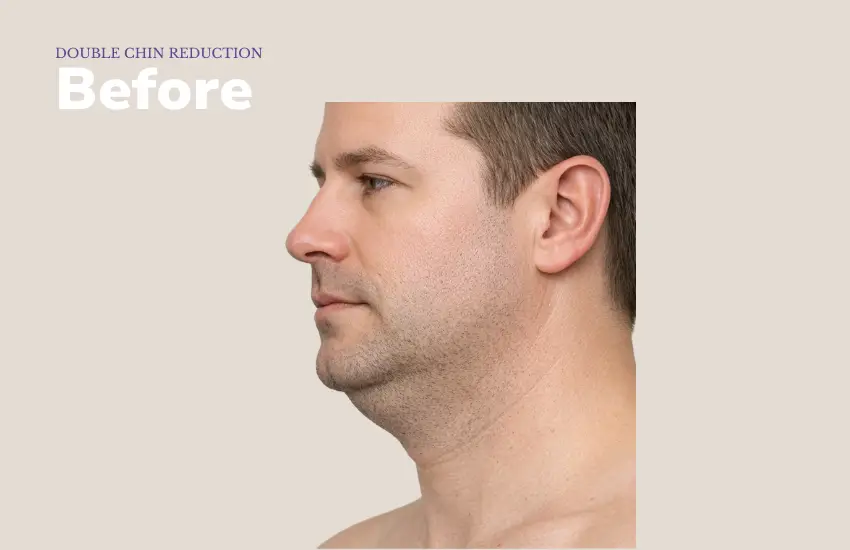 Before double chin treatment