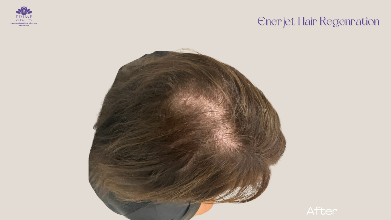 Female scalp after Enerjet treatment showing more coverage