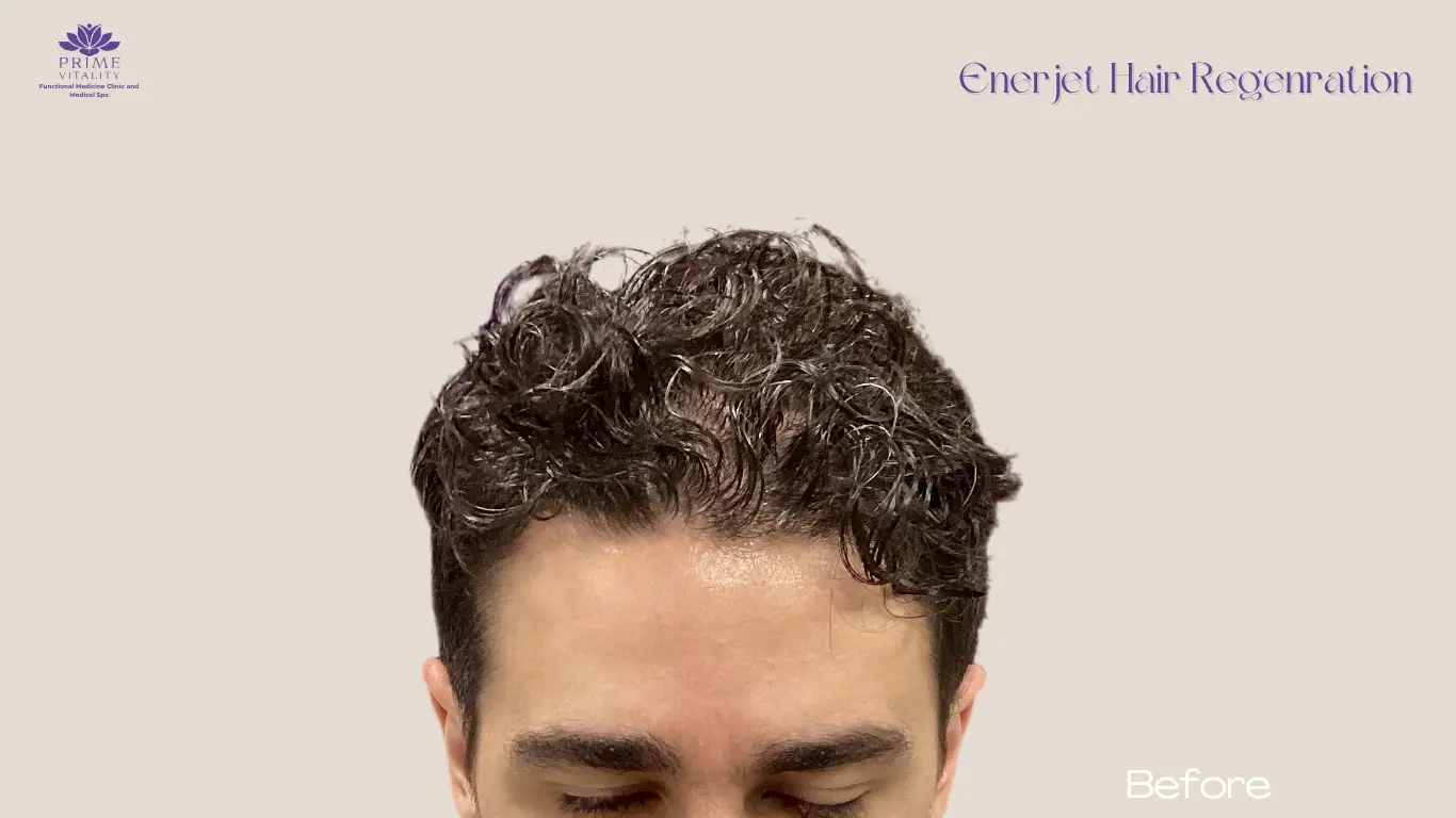 Before PRP therapy with visible scalp
