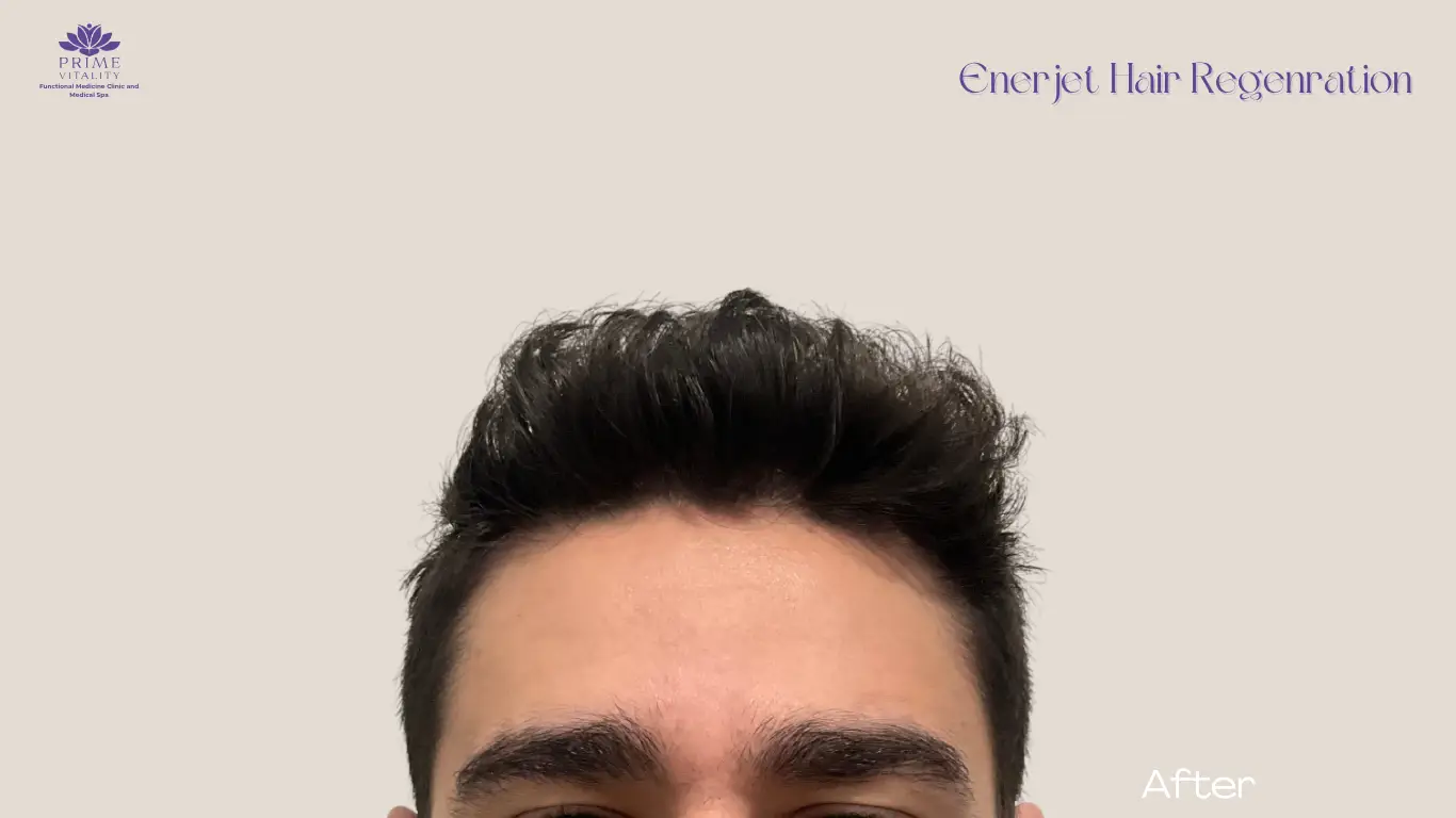 After PRP therapy with thicker coverage