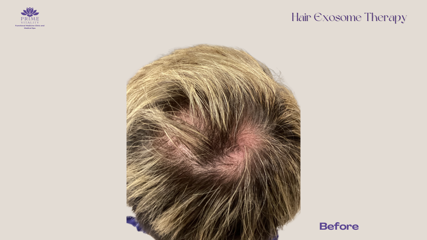 Diffuse thinning before exosome therapy