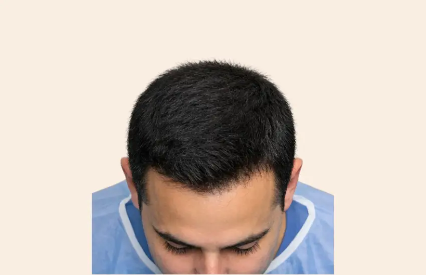 After PRP hair therapy showing improved density at crown