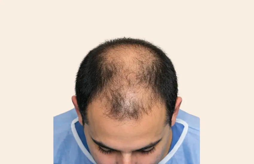 Before PRP hair therapy showing thinning at crown