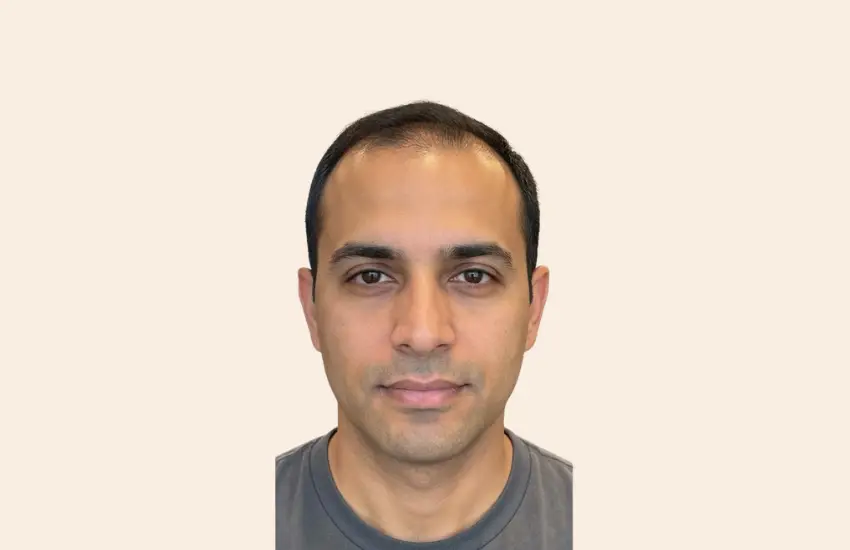Before PRP hair therapy frontal thinning