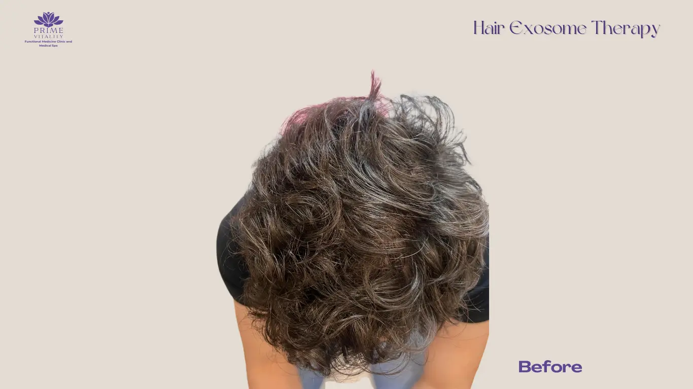 Stronger hairline after PRP and exosome treatment