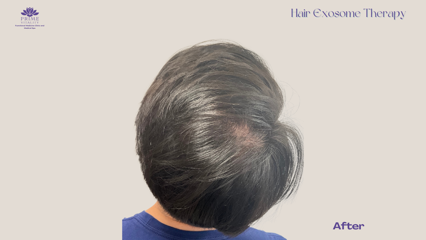 Improved hair volume after exosome therapy