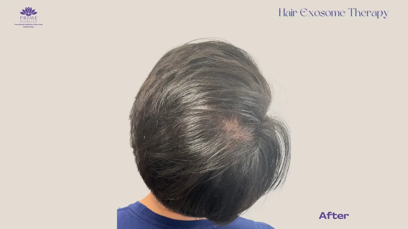 After Enerjet hair restoration with improved density