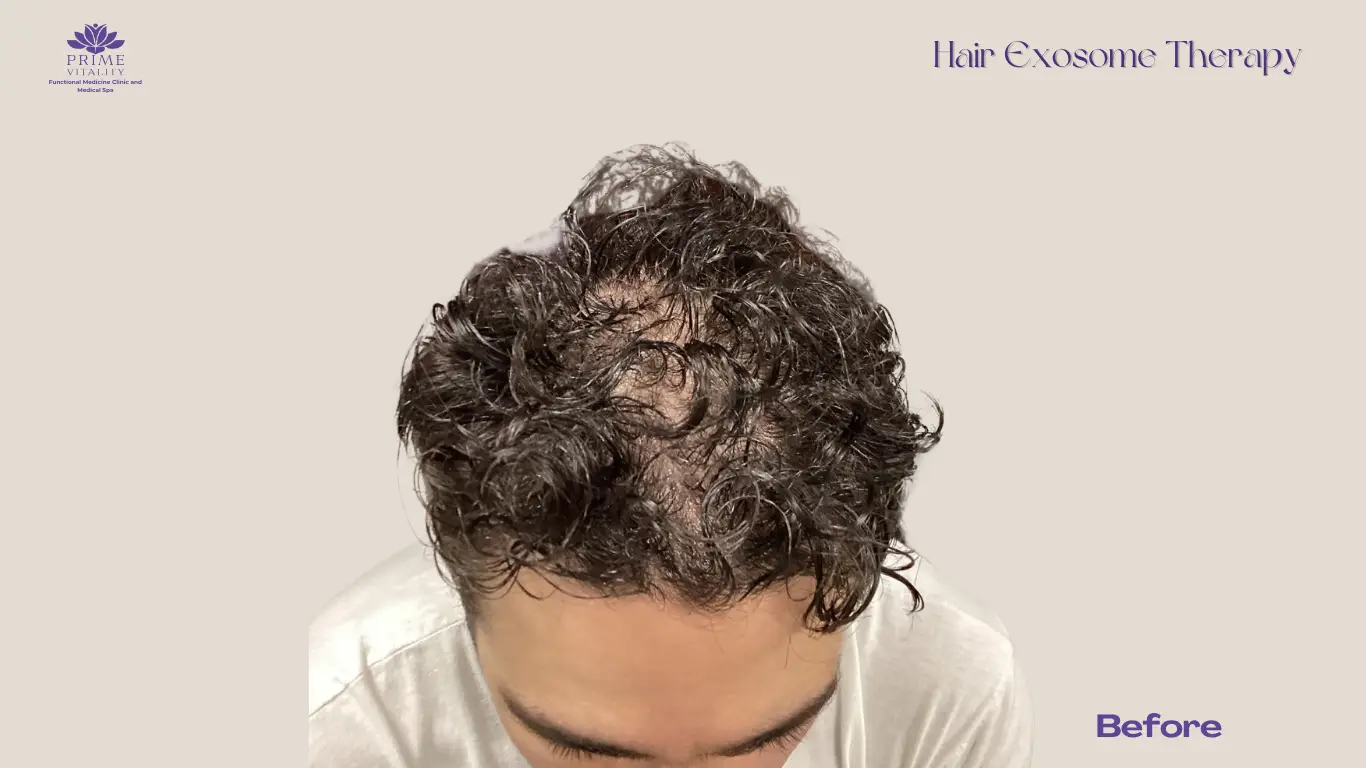 Receding hairline before PRP and exosome combination
