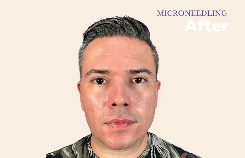 After microneedling treatment — smooth glowing skin