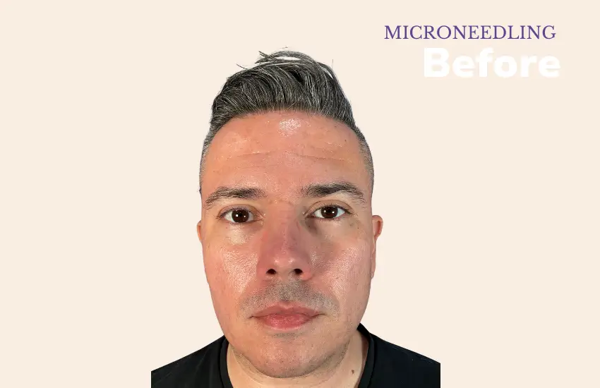 Before microneedling treatment — skin texture