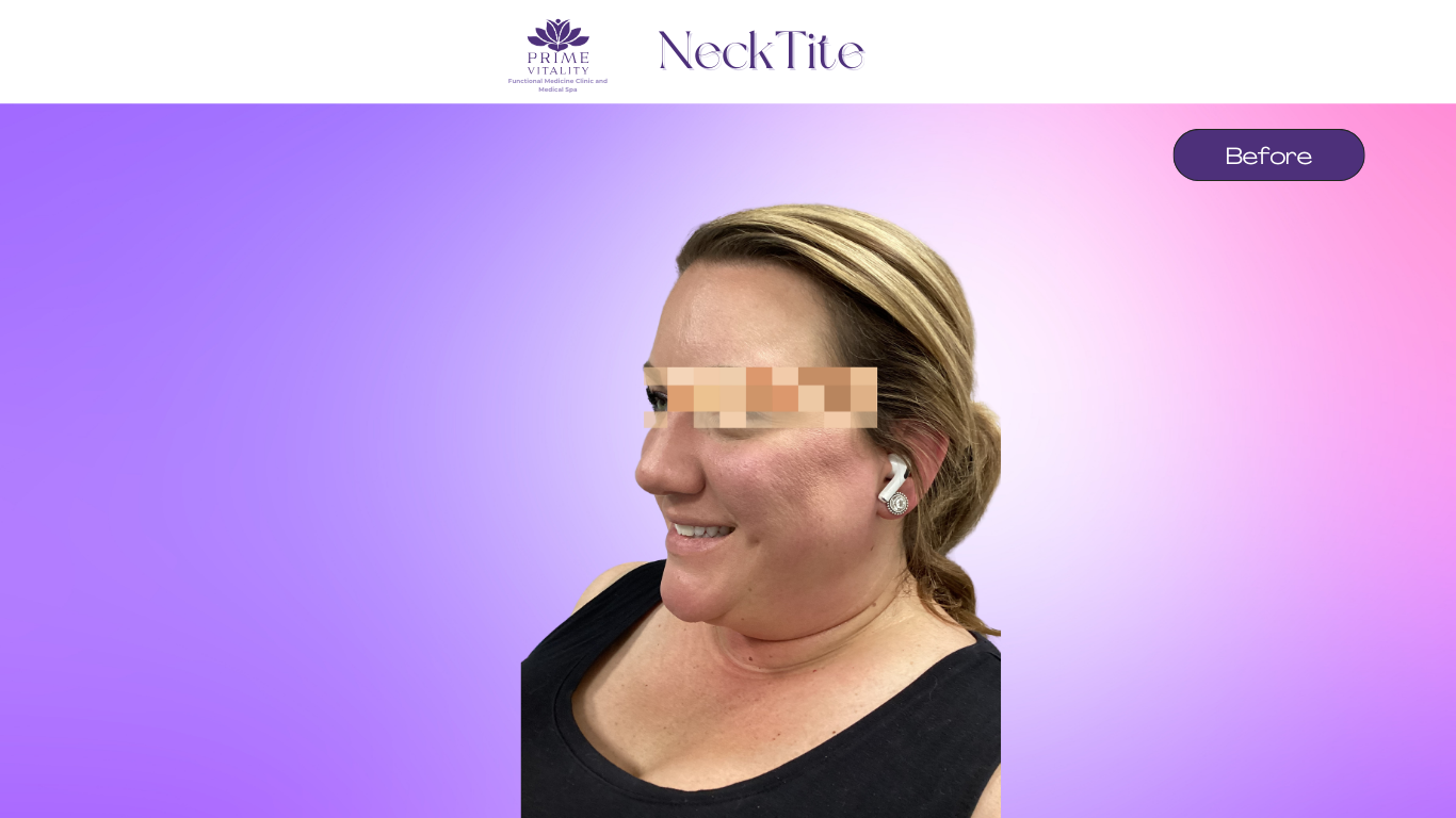 Before NeckTite — turkey neck appearance