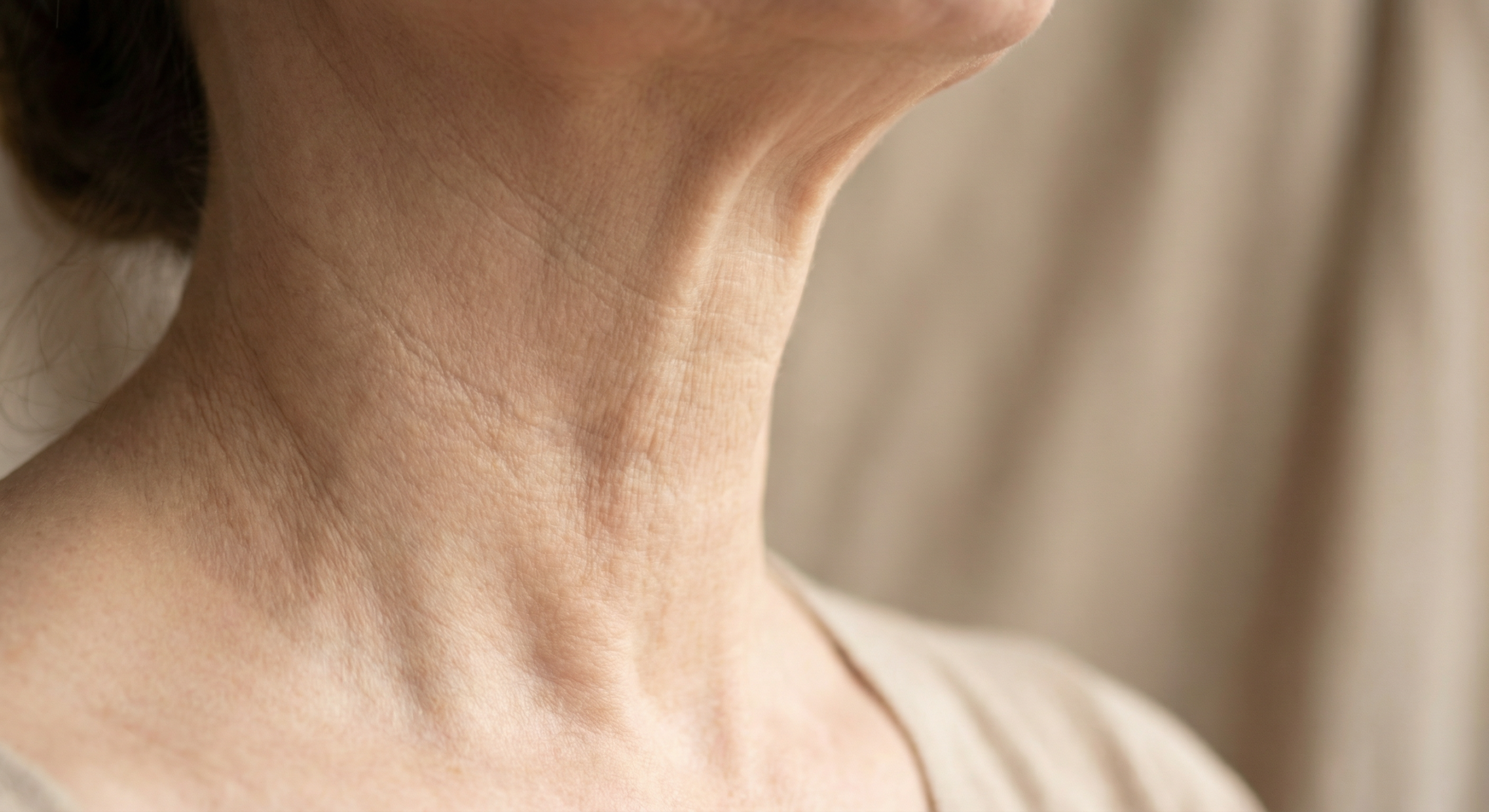 Neck bands platysma treatment