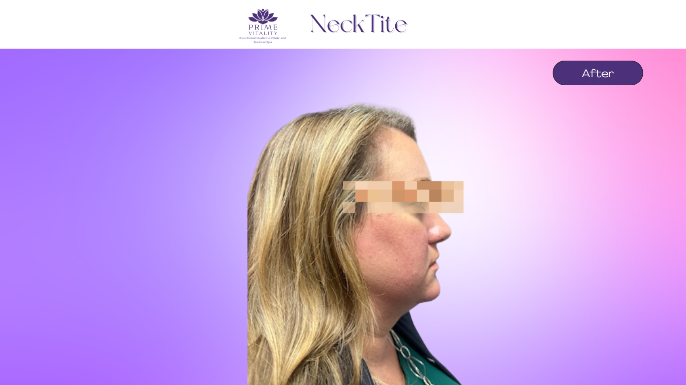 After NeckTite — tightened neck contour