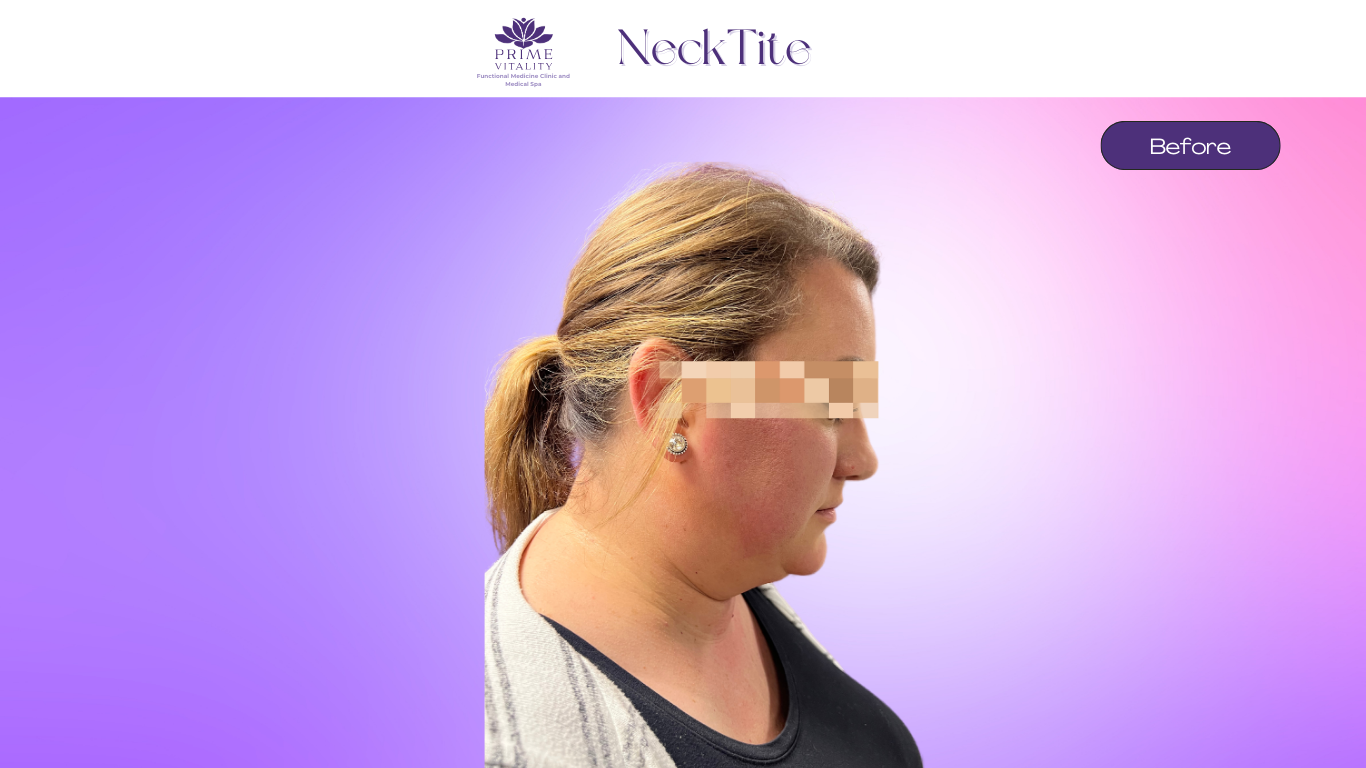 Before NeckTite — loose neck skin