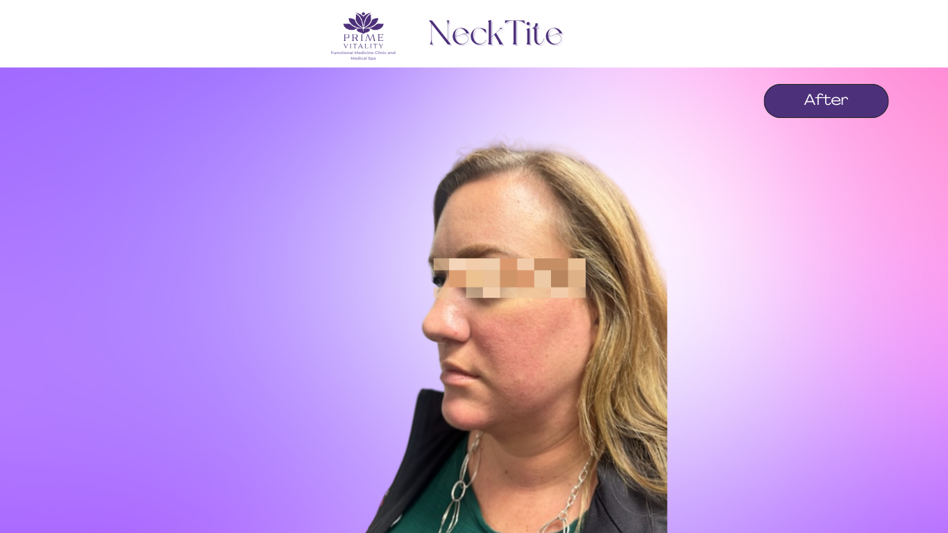 After NeckTite — smooth neck profile