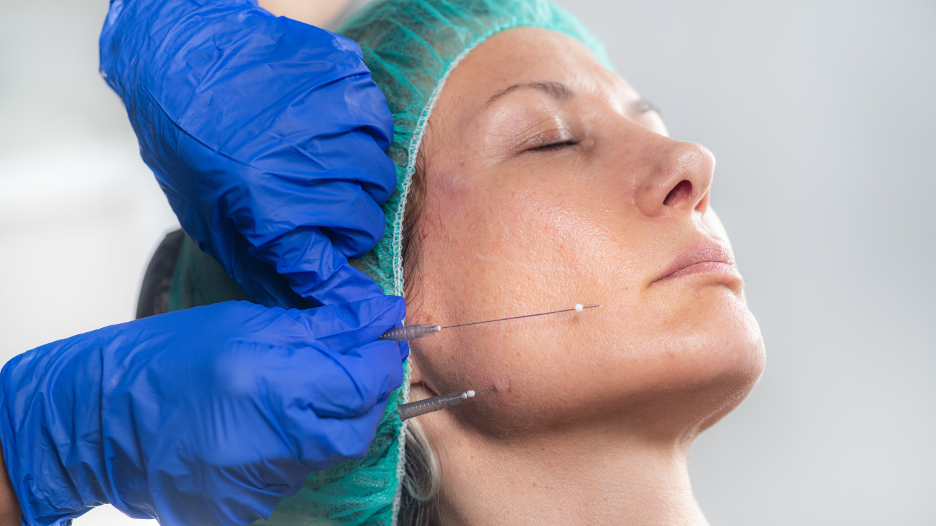Physician performing PDO thread lift procedure on a patient’s face, highlighting non-surgical aesthetic treatment for skin tightening and rejuvenation at Prime Vitality Medical Spa.