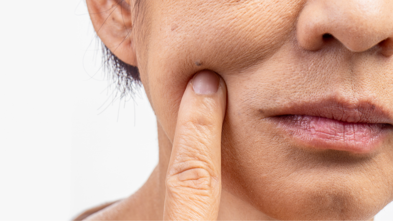 Mild acne scarring on cheek