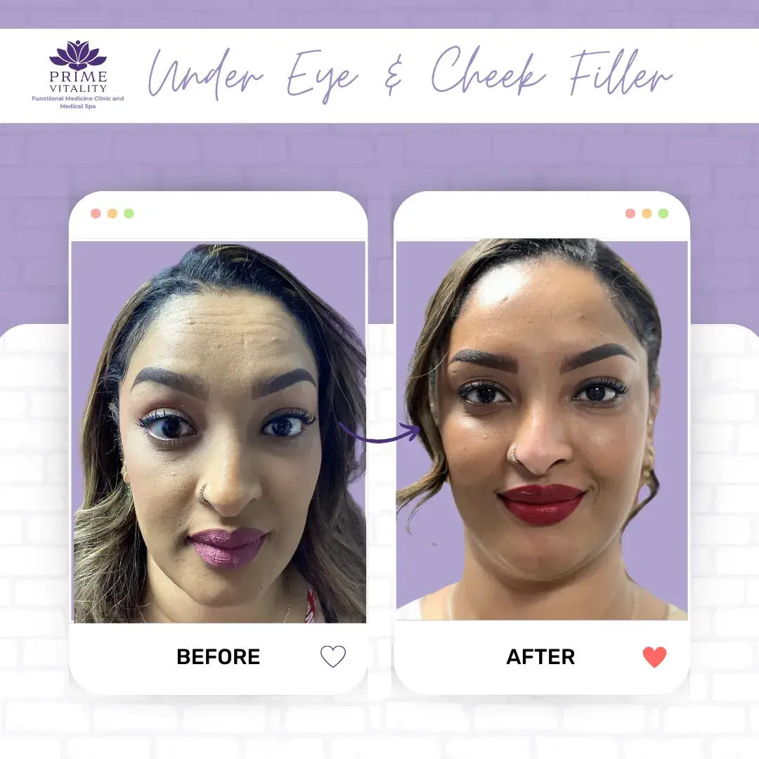 Smiling woman with radiant skin after Botox, chemical peels, and microneedling treatments